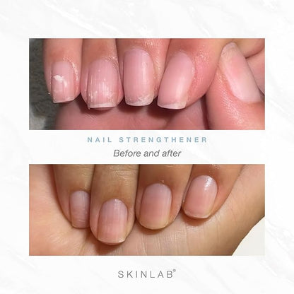 Skinlab’s Premium Nail Strengthening Serum – Boosts Nail Growth & Resilience – Stronger, Healthier, Longer Nails – 3 Month Supply – Dermatologist Tested – Hypoallergenic – Cruelty-Free & Paraben-Free